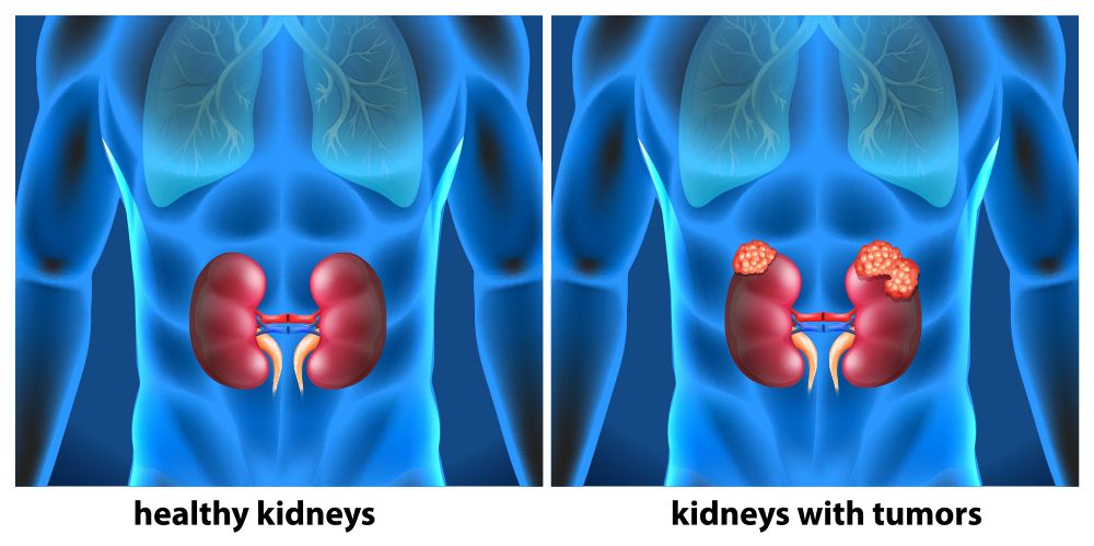 Comparison of healthy kidneys and kidneys affected by cancer